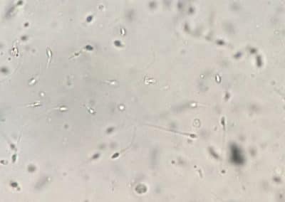 Sperm containing virus raises small risk of COVID-19 spread via sex: study